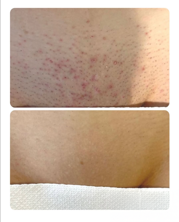 Bikini Area Result 1