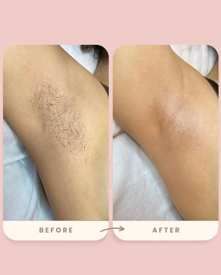 Underarms Result 2