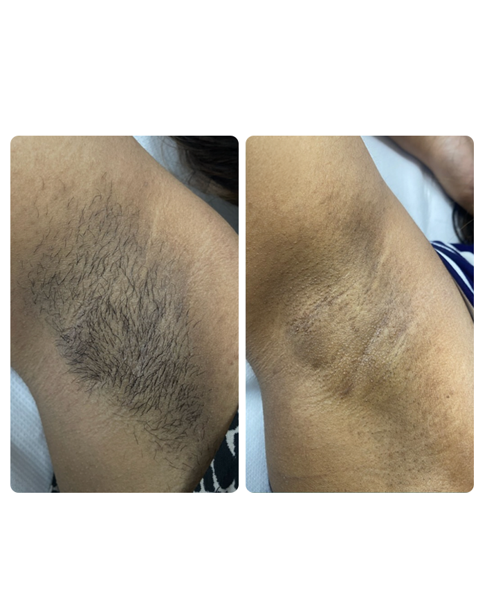 Underarms Result 1