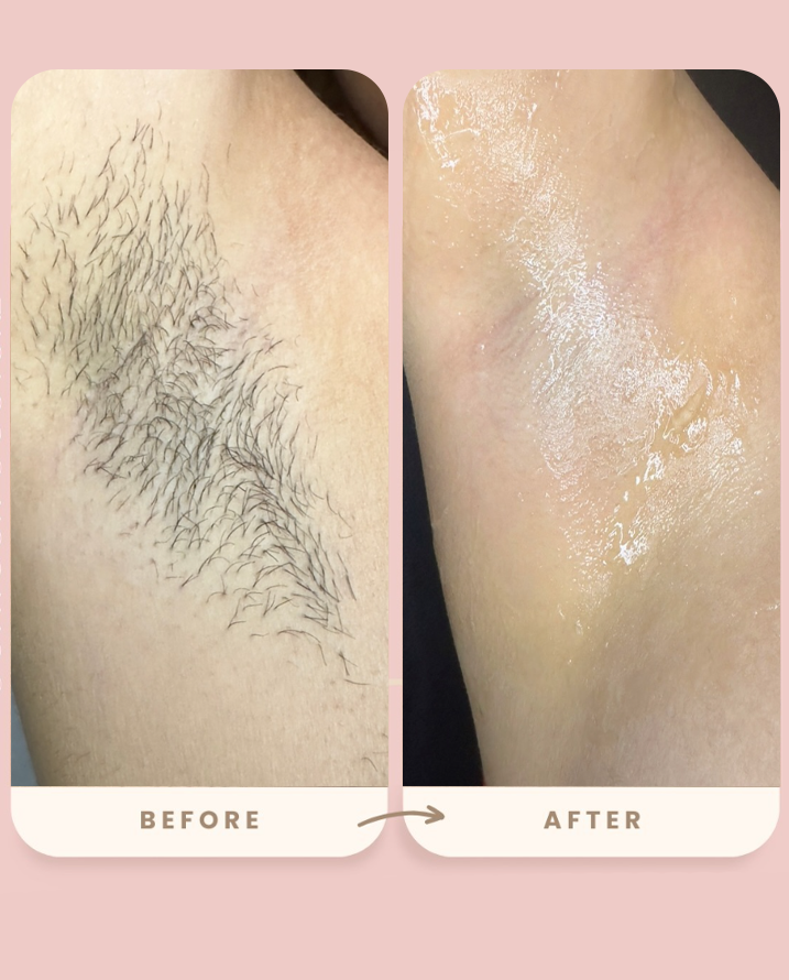 Underarms Result 2